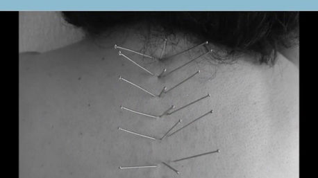 ACUPUNTURA